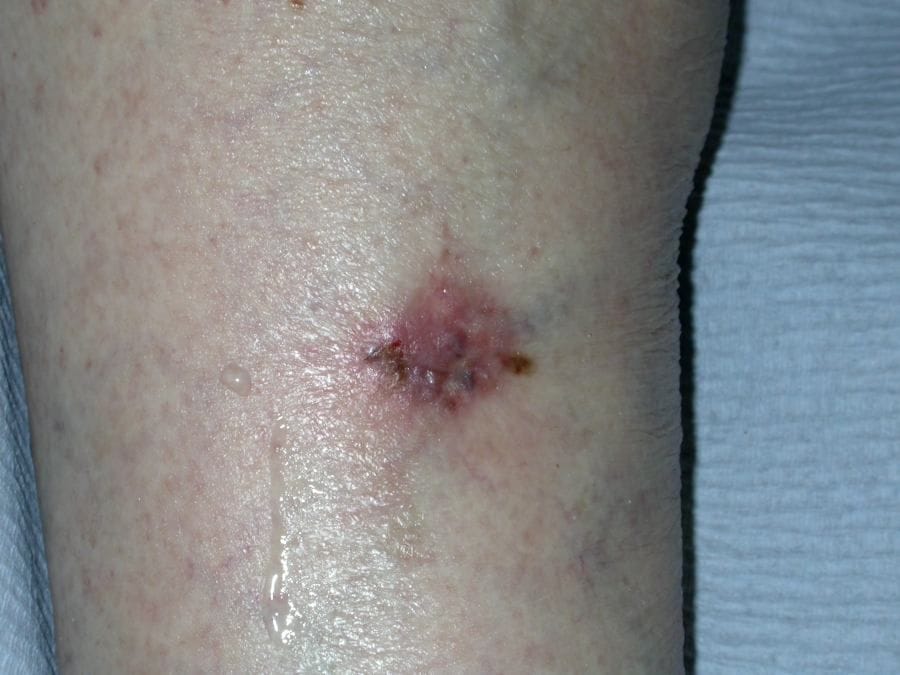 skin cancer basal cell detection