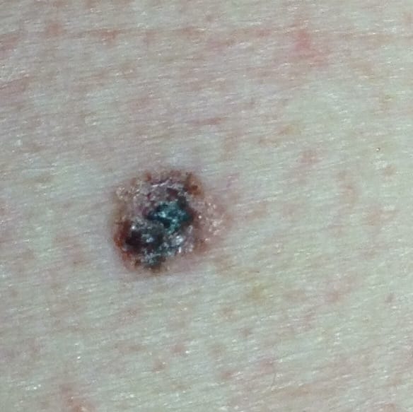 cancer melanoma skin check dr predrag urosevic
