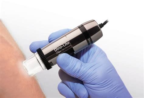 dino-lite skin check diagnosis