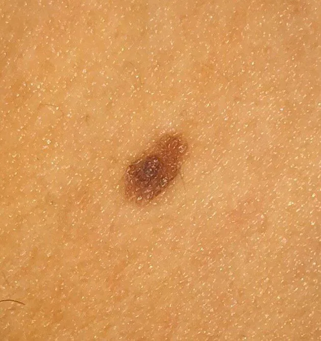 moles skin health specialist