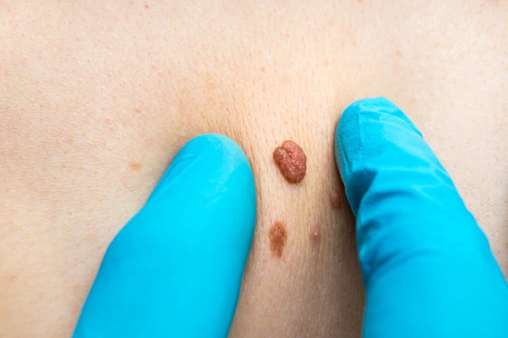 skin check eve health skin mole tag check
