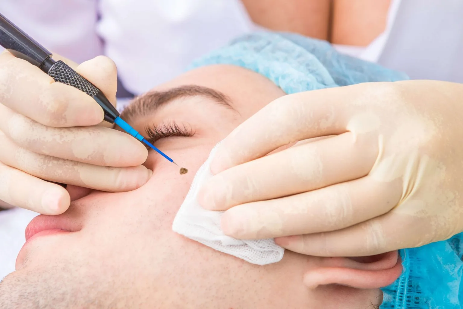 skin check eve mole removal