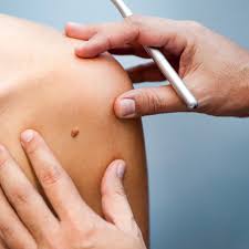 skin check eve skin tag removal diagnosis